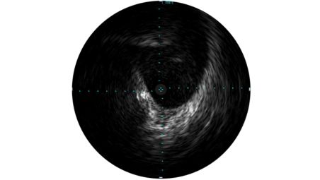 IVUS helps with disease assessment