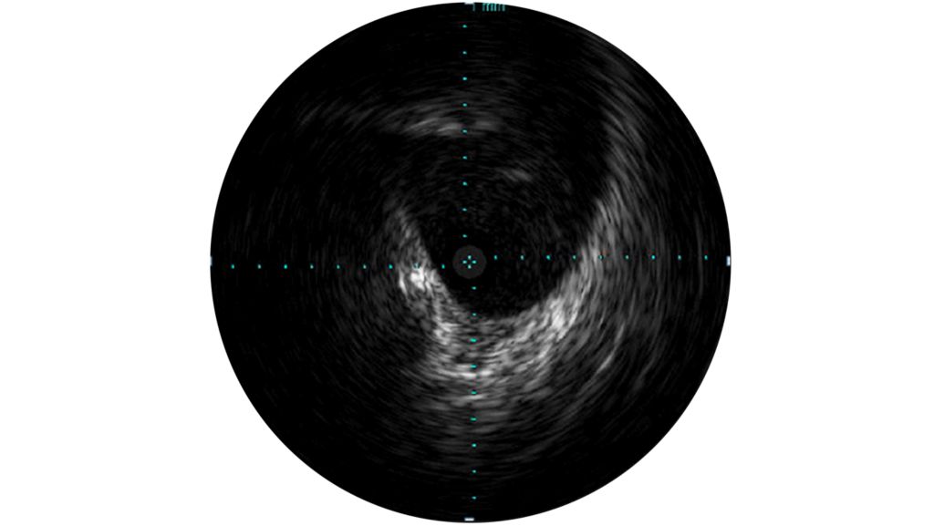 IVUS assesses disease