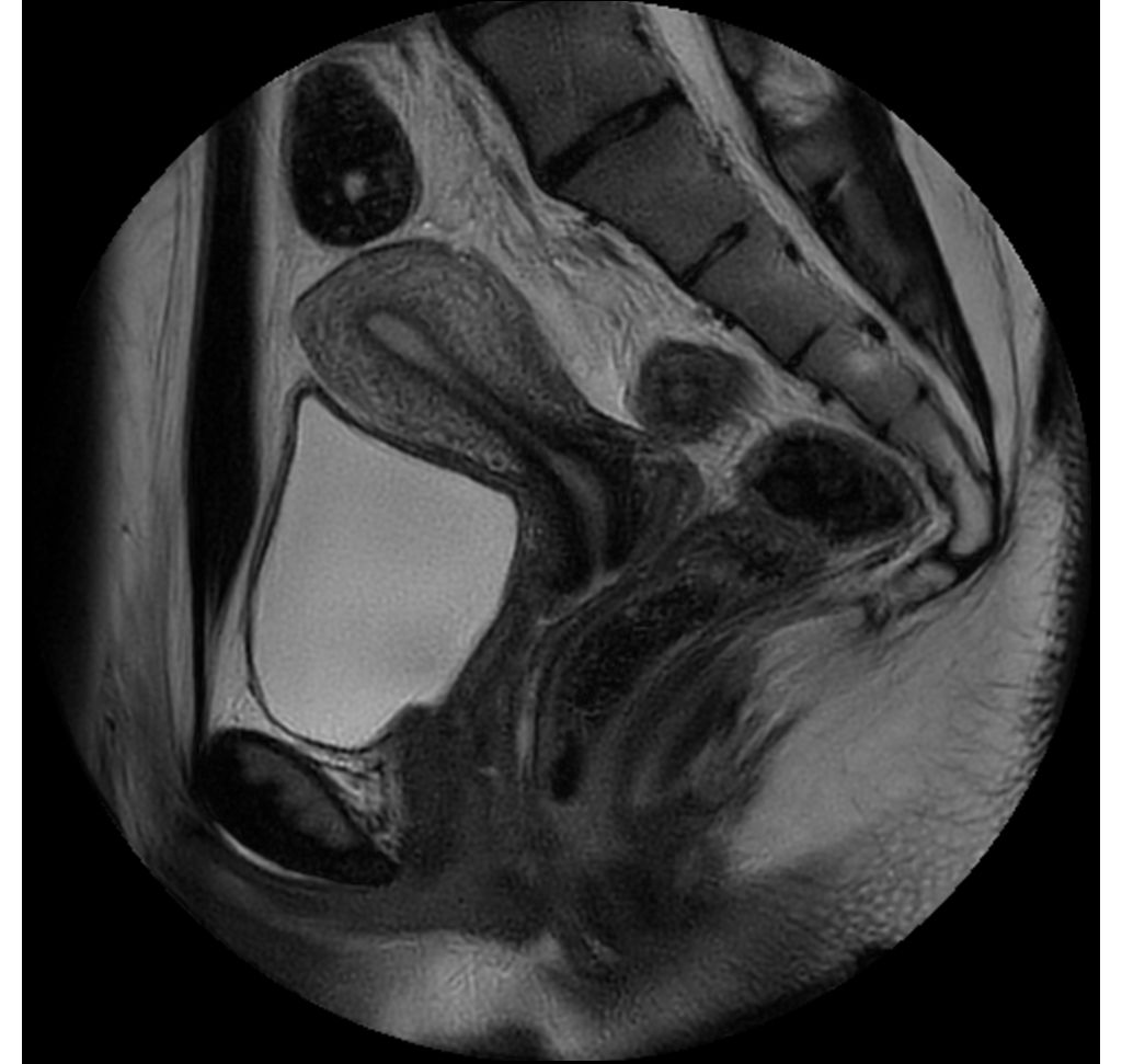 MultiVane XD - Sagittal T2w TSE