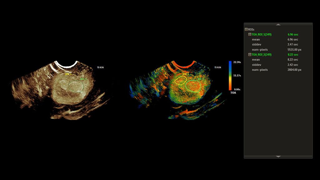 SuperRes MVI Pro quantitative TOA clinical image