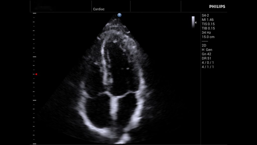 S4-2 Apical 4 Chamber