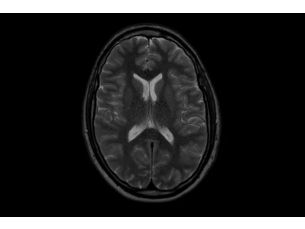 SmartSpeed Precise - Brain MR Clinical Applications