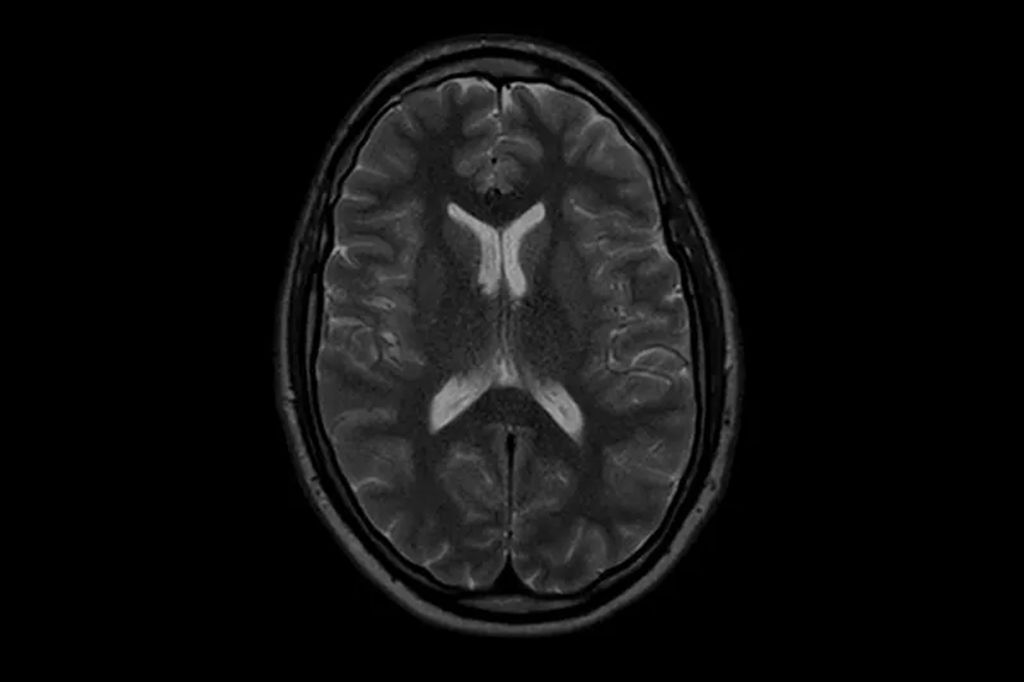 Philips - SmartSpeed Precise - Brain NMRF445B - Philips