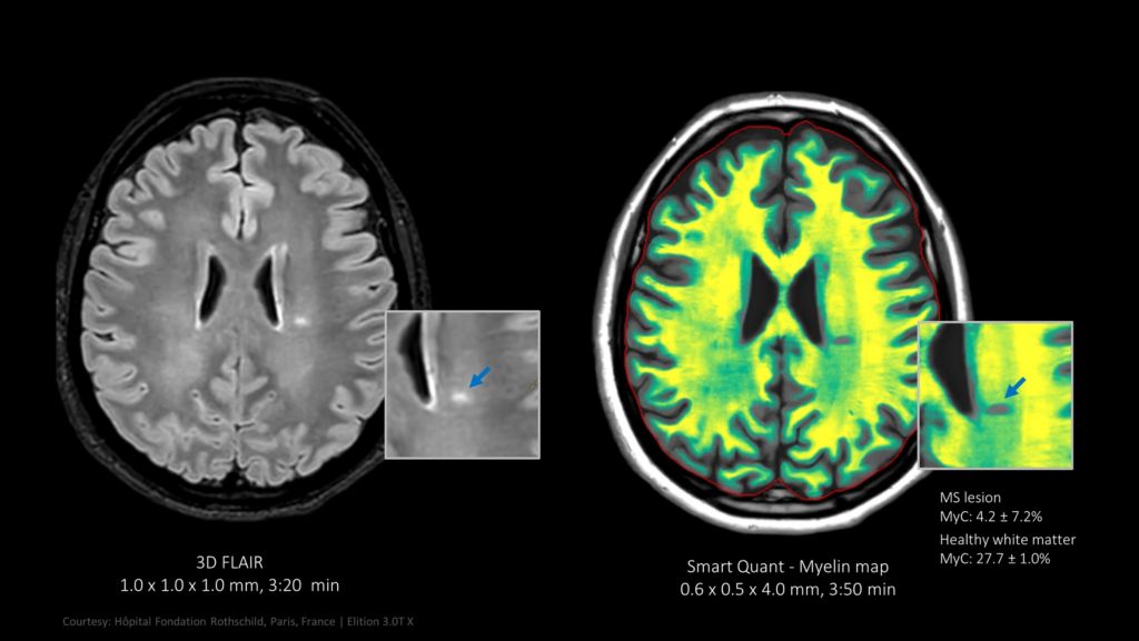 Smart Quant Neuro 3D myelin map