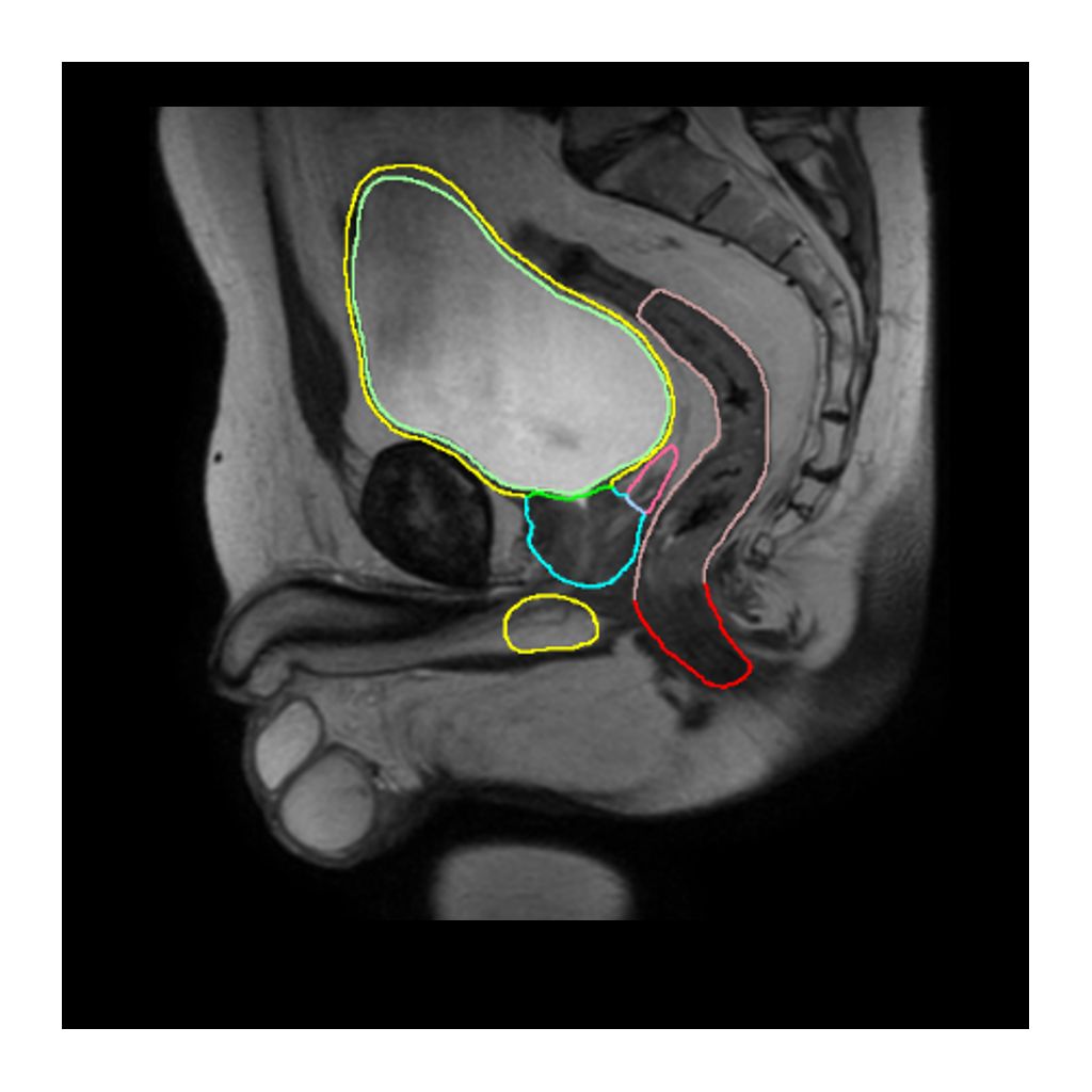 Onesite web image MRCAT prostate