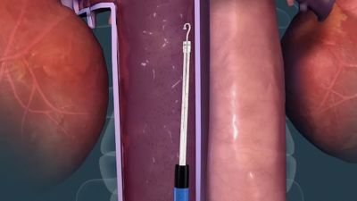 What is a IVC filter - Get In The Know with Dr. Atul Gupta (English)
