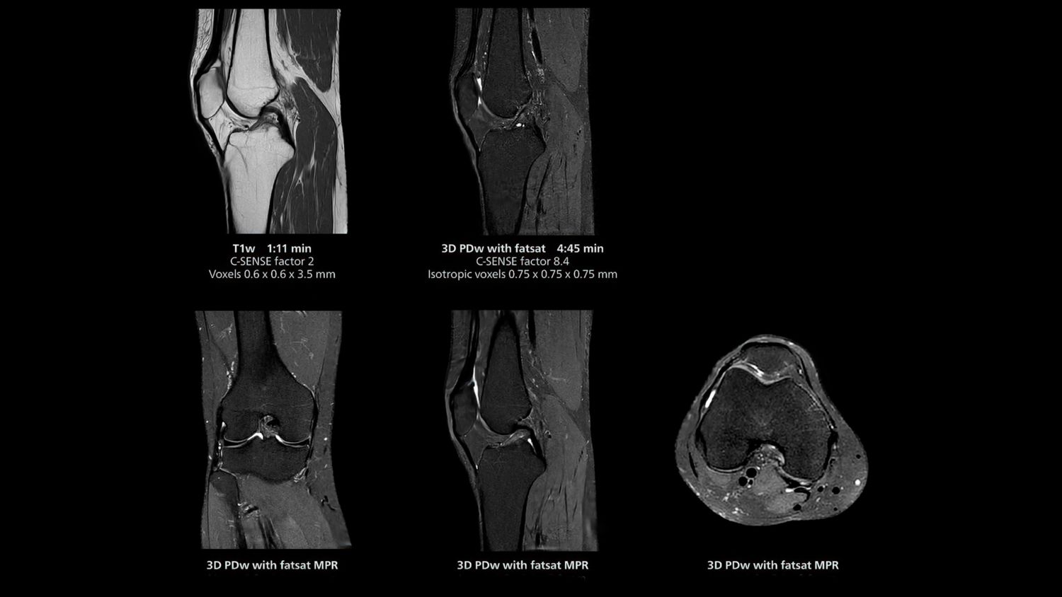 3D knee imaging acquired on Philips MR5300