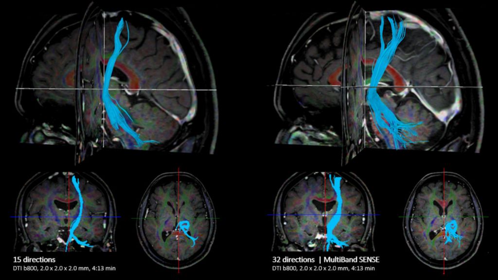 Brain comparison MultiBand SENSE