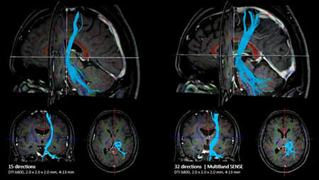 Brain comparison MultiBand SENSE