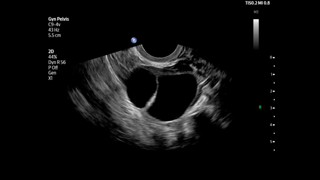 Ovarian cyst shown using C9-4v transducer on Flash 5100 POC