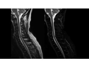 mDIXON XD TSE - Spine MR Clinical application