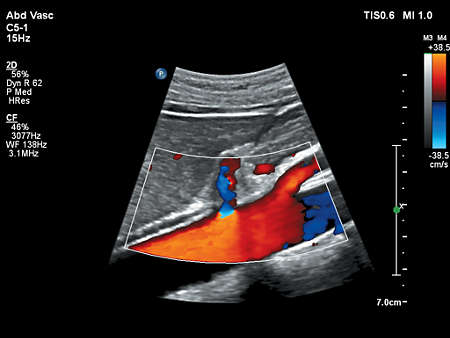 C5-1 Abdominal Vascular