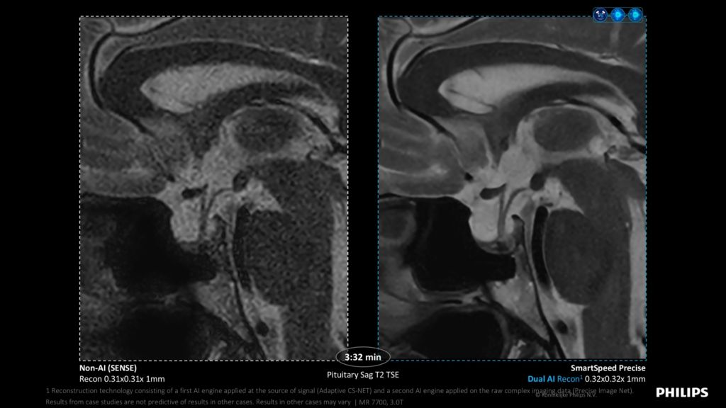 SmartSpeed Precise image sharpness comparison - Pituitary
