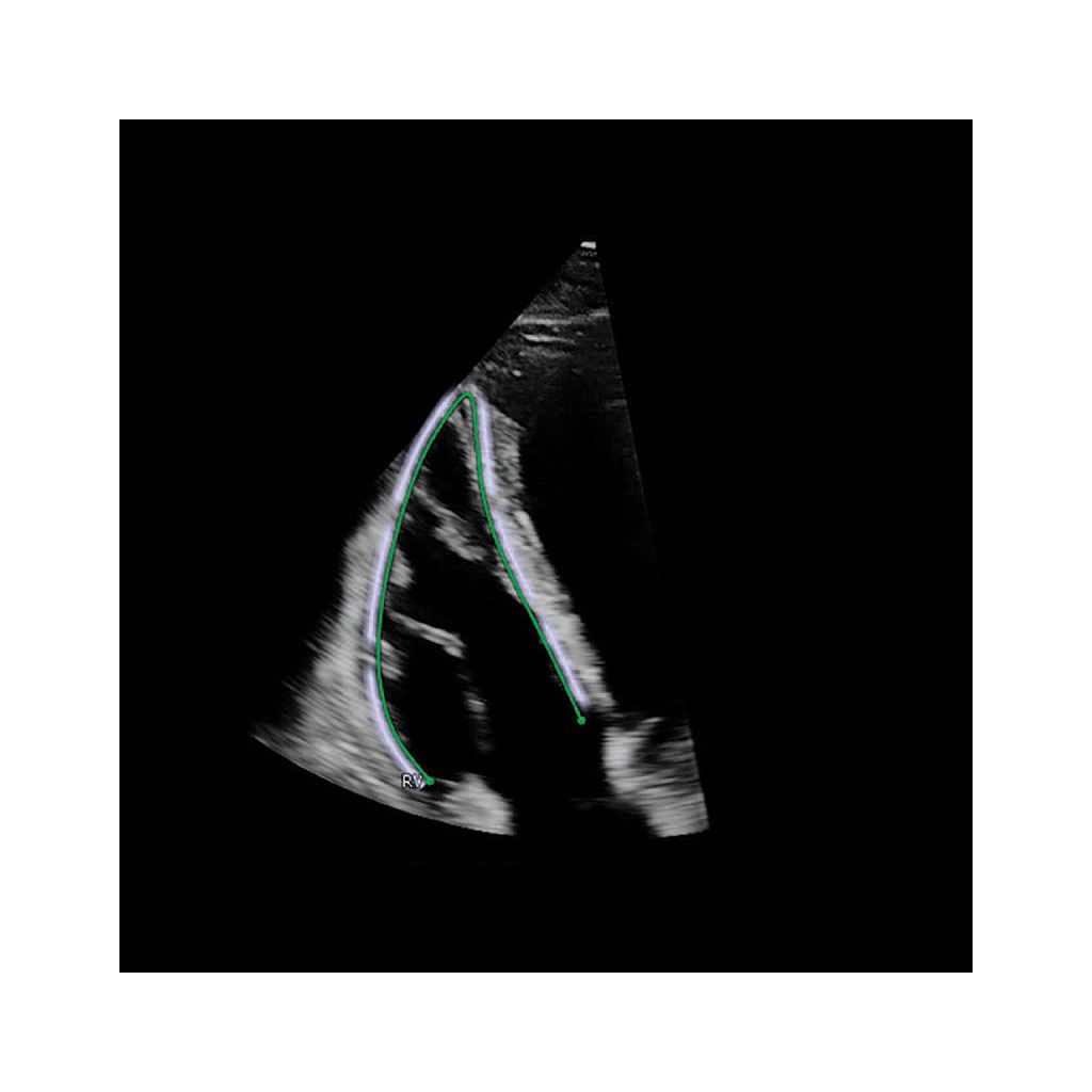 AutoStrain Clinical images showing Auto Contour Placement - V focused view with Auto Contour Placement