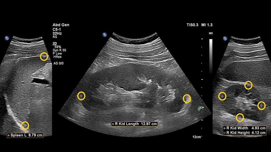 Combined Auto Measurements into one clinical image using EPIQ and C5-1 transducer showing abdominal kidney and spleen with Auto Measure Maxvue with measurements 