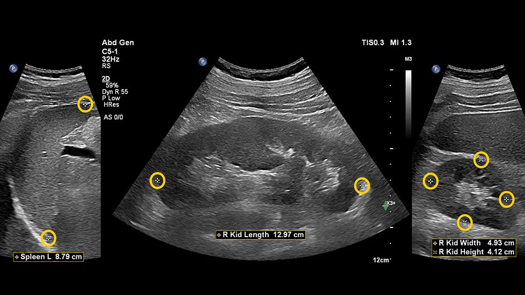 Combined Auto Measurements into one clinical image using EPIQ and C5-1 transducer showing abdominal kidney and spleen with Auto Measure Maxvue with measurements 