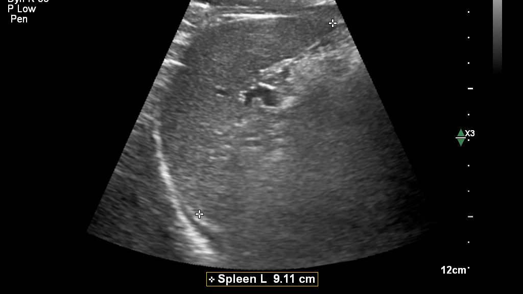 Auto Measure Abdomen Spleen with C9-2 transducer