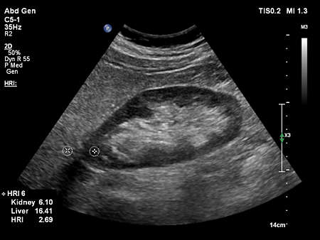 C5-1 Hepatic Renal Index (HRI)