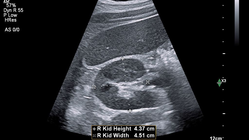 Auto Measure Abdomen Kidney Transverse Width and Height 