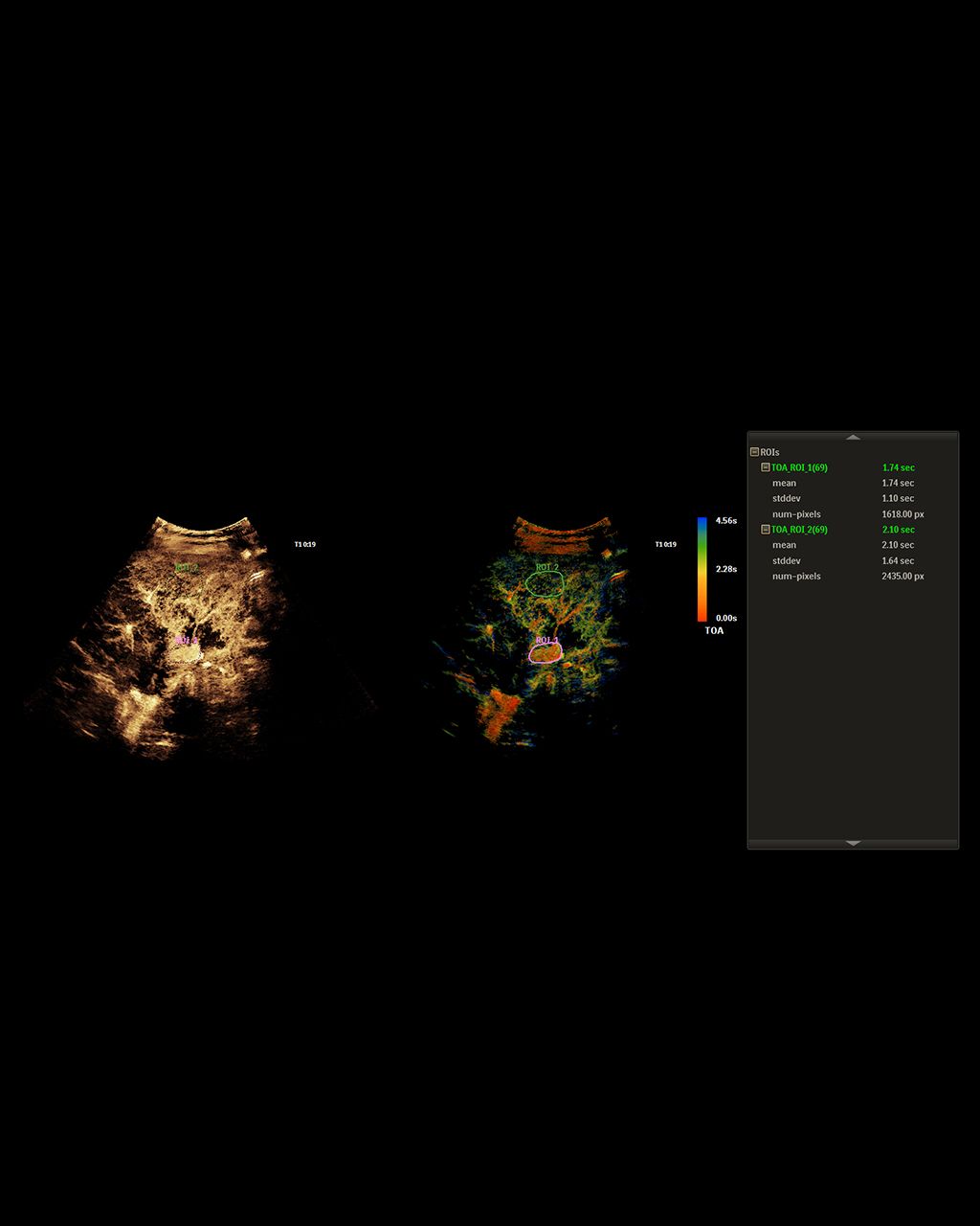  Clearer contrast uptake and lesion characterization image 