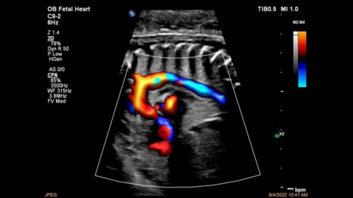 C9-2 Aortic Arch CPA with Flow Viewer
