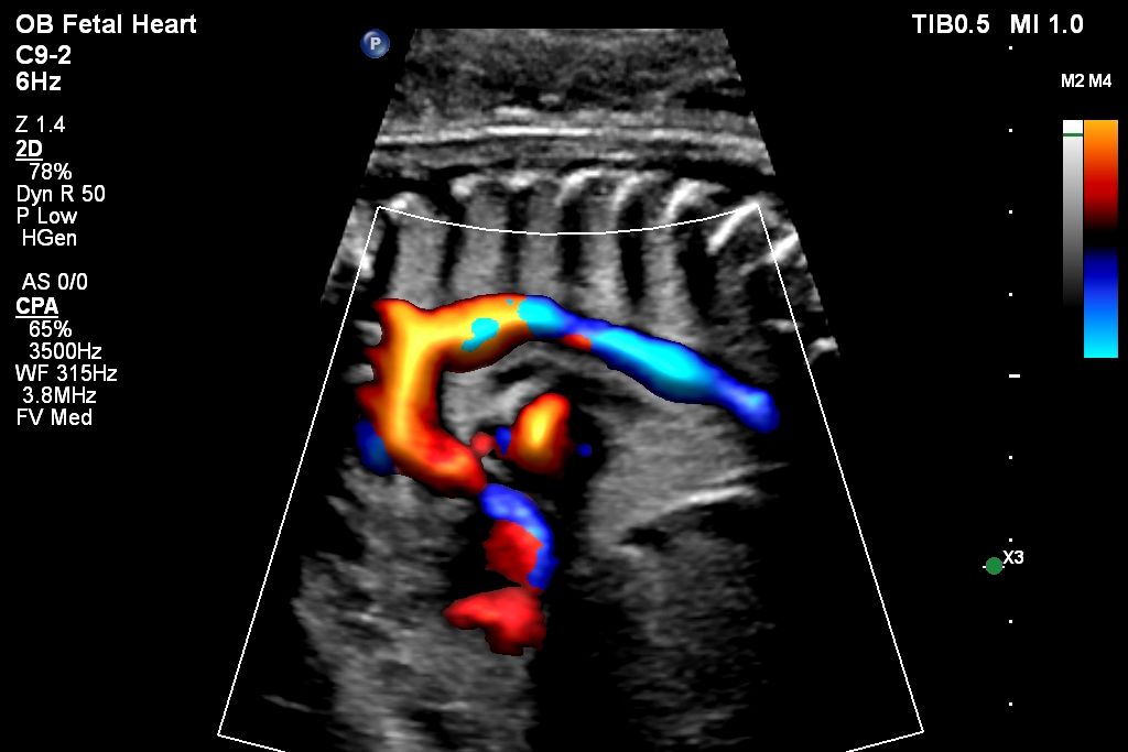 Aortic arch CPA with Flow Viewer using C9-2 transducer