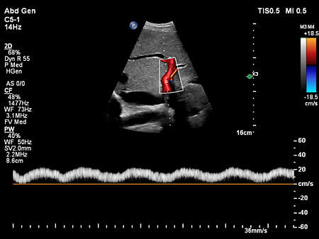 C5-1 Liver Doppler with FlowViewer