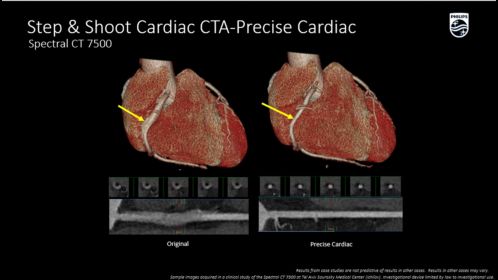 CT Spectral 7500 : Step & Shoot Cardiac
