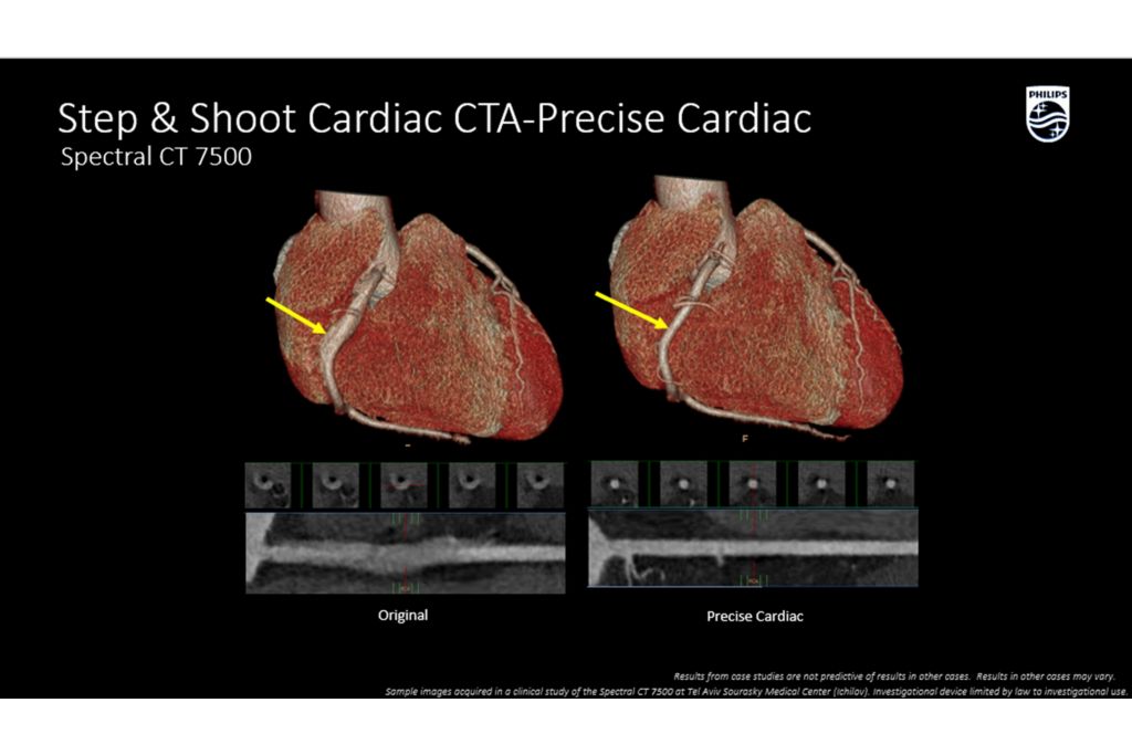 CT Spectral 7500 Step & Shoot Cardiac