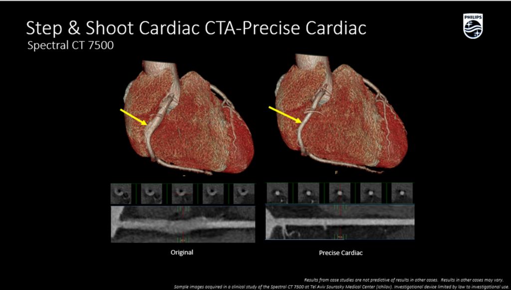 CT Spectral 7500 Step & Shoot Cardiac
