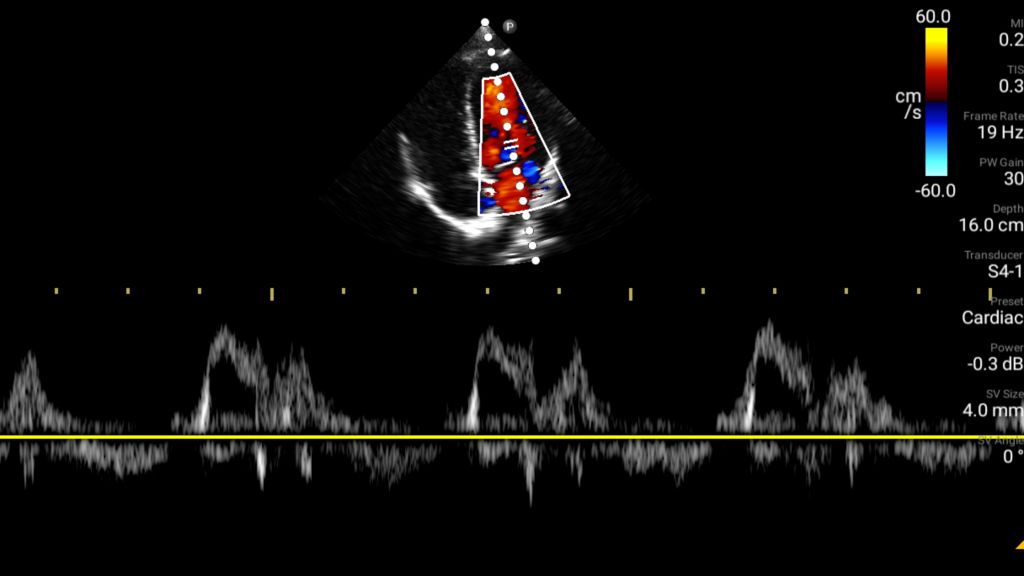 Mitral valve with color and Pulsed Wave Doppler shown using S4-1 transducer