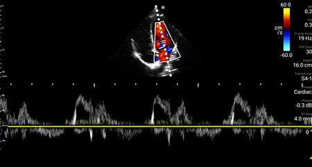 Mitral valve with color and Pulsed Wave Doppler shown using S4-1 transducer.