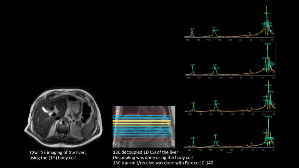 C140 Liver 1D CSI