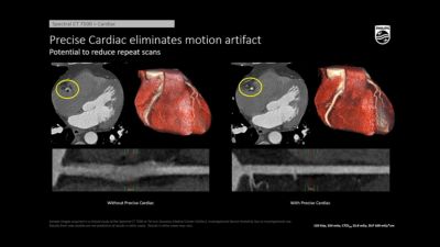 Phần mềm Precise Cardiac ứng dụng AI hỗ trợ giảm nhiễu chuyển động trong chụp CT động mạch vành