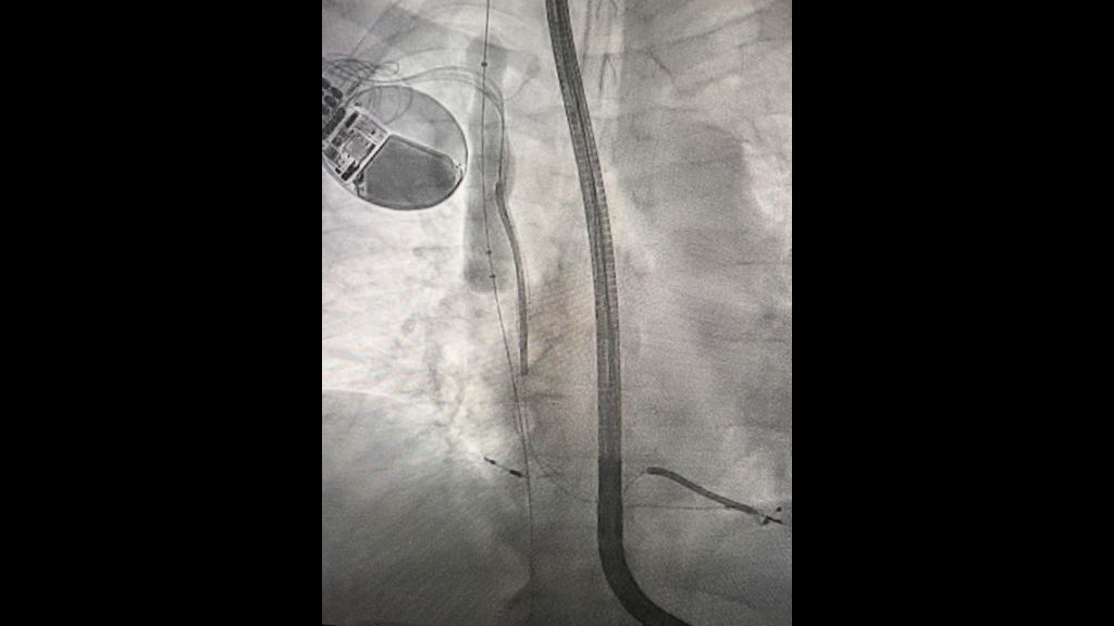 Fluoroscopy of Bridge Plus – Image courtesy of Dr. Kiel, Sentara