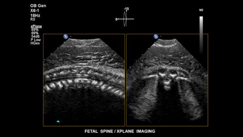 Fetal spine. xPlane Imaging