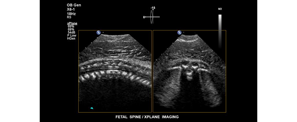 Fetal spine. xPlane Imaging