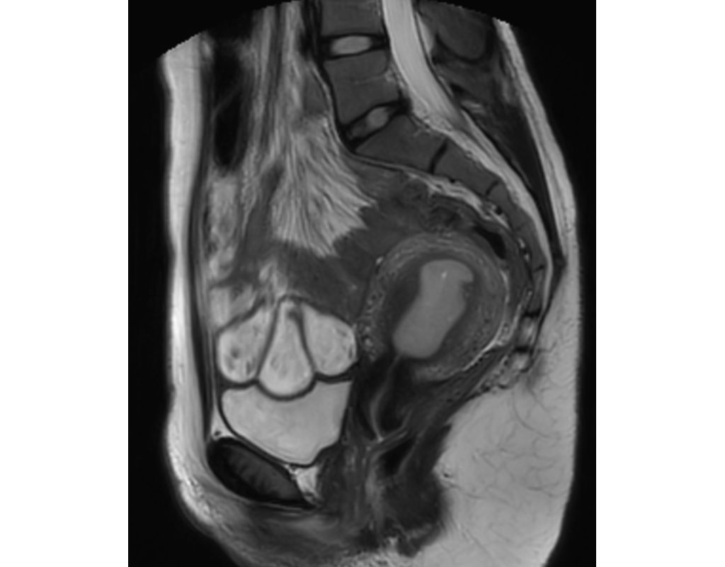 MultiVane XD - Sagittal T2w TSE