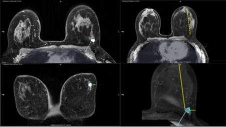 Lesion segmentation enhances workflow efficiency