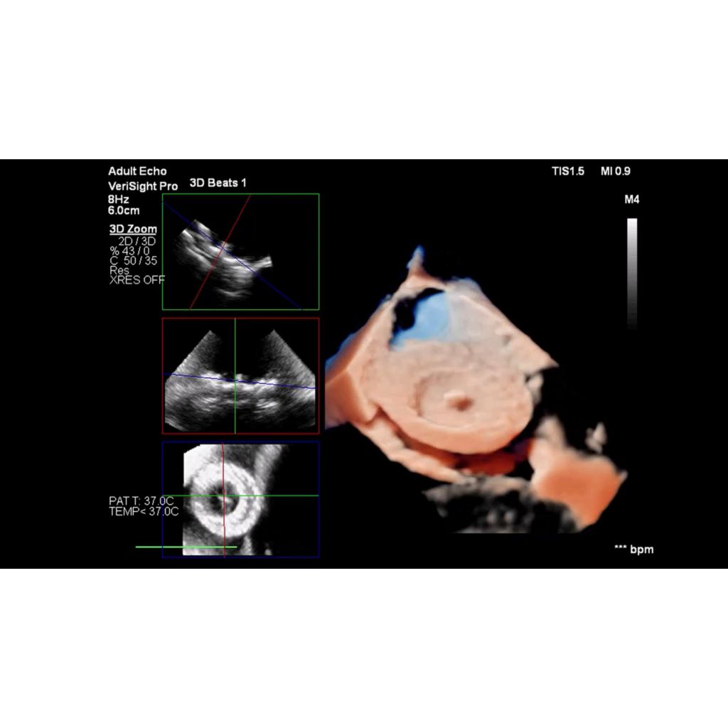 Accurately assess ASD/PFO