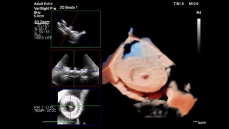 Accurately assess ASD/PFO