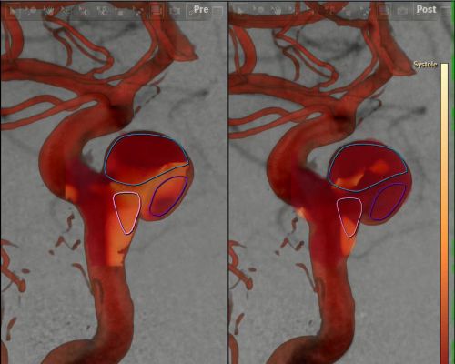 AneurysmFlow clinical image