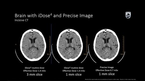 Incisive CT Cerveau avec iDose4 et Precise Image