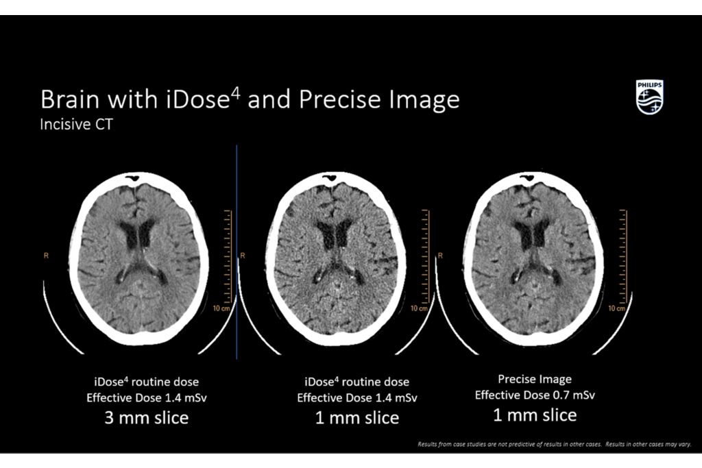 Incisive CT brain with iDose4 and precise image