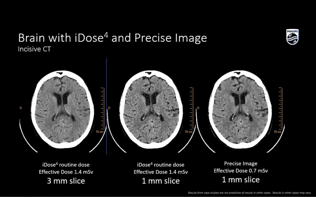 Incisive CT brain with iDose4 and precise image