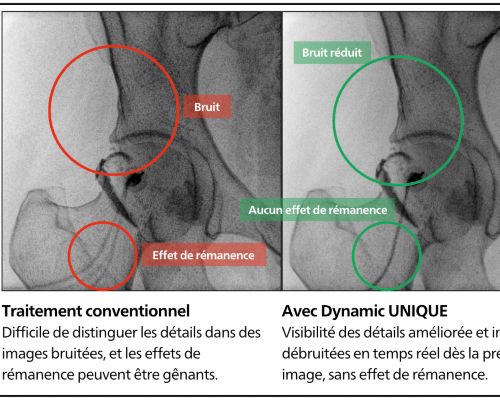 Suppression du bruit temporel et spatial