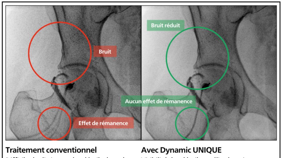 Suppression du bruit temporel et spatial