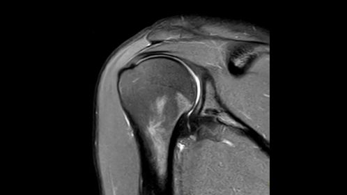 Coronal PDw SPAIR TSE with DRIVE - Shoulder