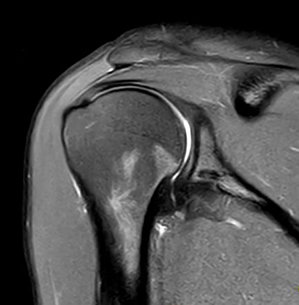 Coronal PDw SPAIR TSE with DRIVE - Shoulder