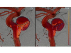 AneurysmFlow Цветовая динамическая кодировка кровотока в церебральной аневризме